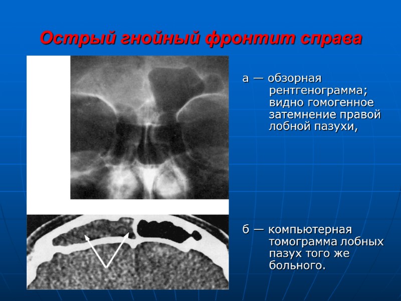 Острый гнойный фронтит справа а — обзорная    рентгенограмма;   